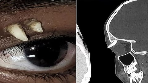 A rare condition where a tooth grows under the eye; what is an ectopic tooth?
