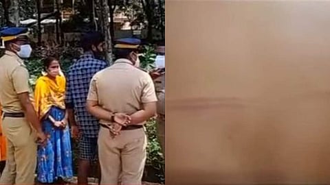 കാട്ടാക്കടയില് പൊലീസിന്റെ മര്ദ്ദനമേറ്റ വിദ്യാര്ത്ഥിയുടെ ശരീരത്തിലെ പാട്