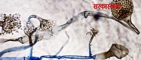 Black Fungus in 13 year boy first case in Gujrat