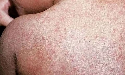 Measles cases up 35 percent nationwide