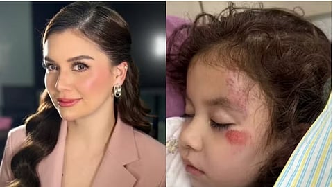 Nadine Samonte’s daughter hospitalized after head injury