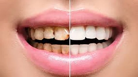 മോണരോഗത്തെ ചിരിച്ചു തള്ളരുത്, ചിരിക്കു വില കൊടുക്കേണ്ടി വരും