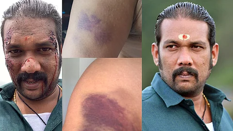 ‘അയ്യപ്പന് നായരുടെ ചവിട്ട് നെഞ്ചത്ത് വാങ്ങിയ കുട്ടമണിയുടെ അവസ്ഥ’, ചിത്രങ്ങള് പങ്കുവെച്ച് സാബുമോന്