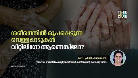 എന്താണ് വിറ്റിലിഗോ ? ലക്ഷണം, പ്രതിരോധം