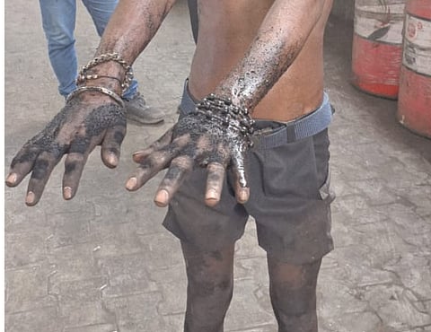 A rescued minor showing his burnt hands.
