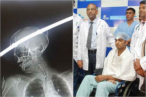 A miracle in the ER: He came in with a rod through his head, but he left alive