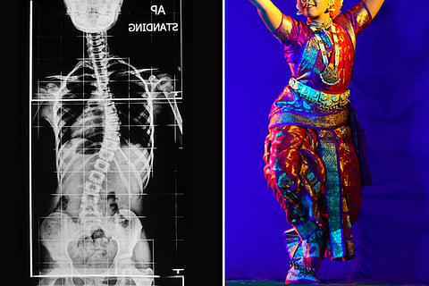 This girl had a curved spine, now she is a Bharatanatyam dancer thanks to a miracle surgery