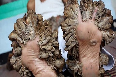 Meet the world’s fourth Tree man who has branches growing out of his hands and feet