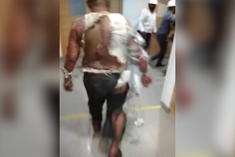 Engineer injured in Bengaluru power plant fire succumbs to burns