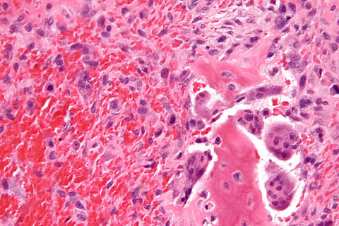 Destroying tumours with gold nanoparticles: The new hope in cancer treatment