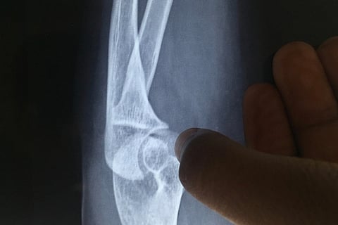 Osteoporosis affects scores of menopausal women, here’s what you need to know