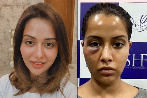 Raiza Wilson's image before the skin treatment on the left and after the skin treatment on the right.