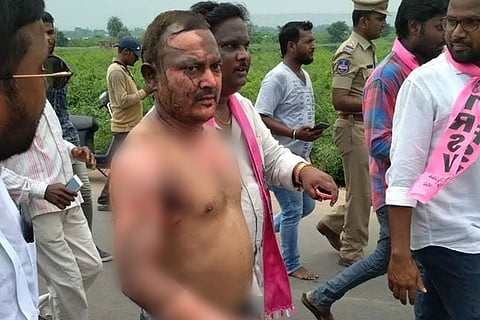 TRS worker who self-immolated for MLA dies, even as leader and KCR patch up