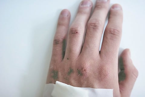 Monkeypox symptoms