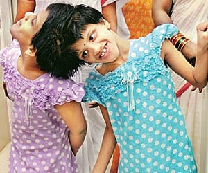 Conjoined twins Veena and Vani, who are currently at the Niloufer hospital