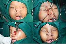 Surgeon drills through nine-year-old’s mouth to reshape face