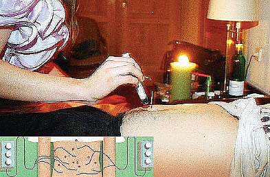 Electro-Acupuncture, an Effective Way to Zap That Fat Forever
