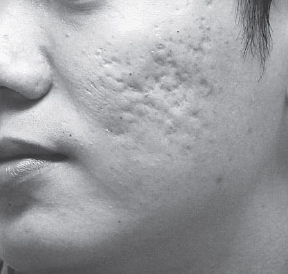 Save yourself from scarring 