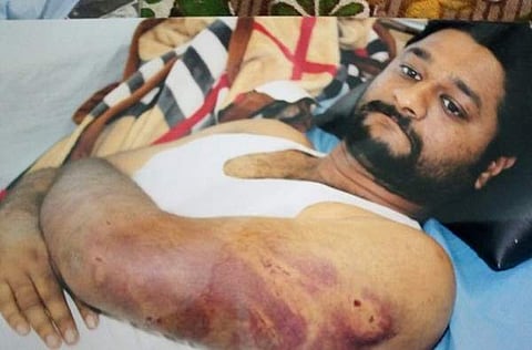 File picture of Vivek Shetty, who was assaulted by BJP Kagwad MLA Raju Kage and his family over personal and political enmity. ( Express Photo )