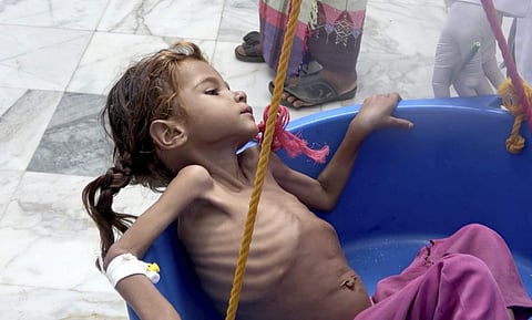 In this Aug. 25, 2018 file image made from video, a severely malnourished girl is weighed at the Aslam Health Center in Hajjah, Yemen. | AP