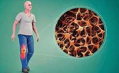 Take care of bone bank deposit before it’s too late