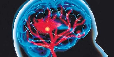 Be stroke aware