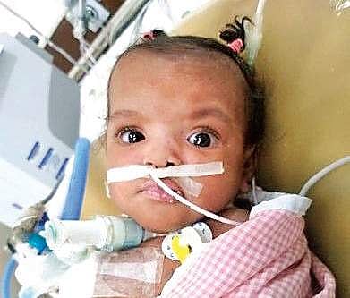 Two-months-old Cleanne Papillion survives the thoracopagus separation surgery | Express