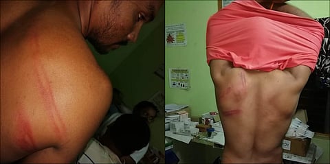 Assault marks on forest staff after they were beaten with sticks by  land encroachers in Telangana's  Thimmampet on Tuesday morning. (Photo | EPS)