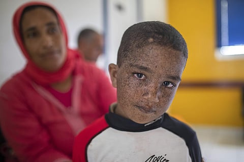 Mohammad, 6, who is affected by a rare disorder called xeroderma pigmentosum, or XP, waits with his mother inside a hospital in Casablanca, Morocco. | ( Photo | AP )