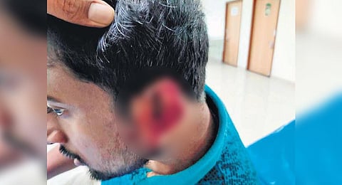 Dr Sakil Khan whose ears were bitten off by  Tarini Mohapatra, on refusal to the entry inside the labour room.