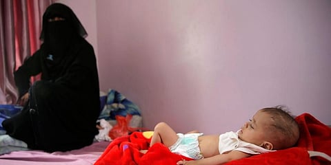 A malnourished boy lies in a bed waiting to receive treatment at a feeding center at Al-Sabeen hospital in Sanaa, Yemen. (Photo | AP)