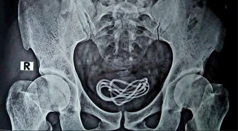 The mobile charger that was found in the man's bladder.
