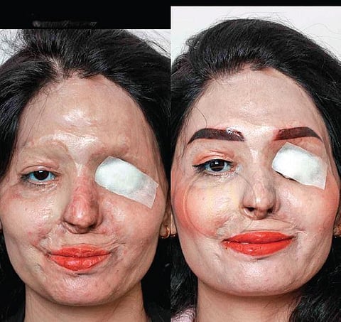 With clinics in Gurugram, Noida, South Delhi, Jalandhar, and Amritsar, Timeless Promise offers other treatments such as Permanent Lip Color and Scalp Micropigmentation.