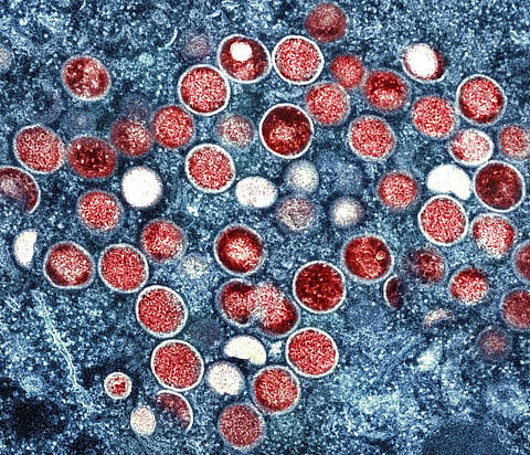 Colorized transmission electron micrograph of monkeypox particles (Photo | AP)