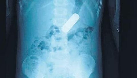 Bengaluru: Four-year-old wins battle against battery lodged in stomach