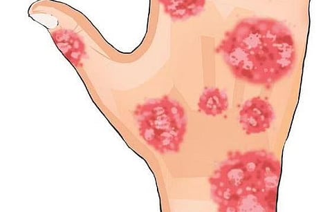 Behind the marks of psoriasis