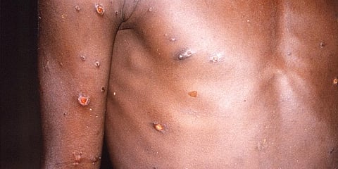 The right arm and torso of a patient, whose skin displayed a number of lesions due to monkeypox. (Photo | AP)