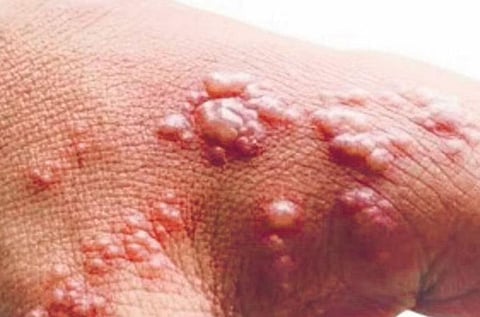 Decoding monkeypox