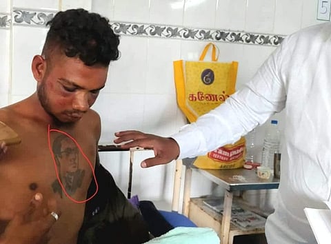 In a recent incident in Tamil Nadu's Vellore, a Dalit youth Saravanan was assaulted severely after caste Hindu gang noticed Dr Ambedkar tattoo on his chest. (Photo | EPS)