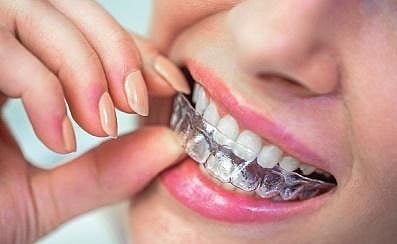 Invisible aligner