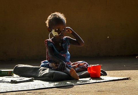Two year old Akon Morro, who is anemic and suffers from edema due to malnutrition, sits on the floor of a feeding center in Al Sabah Children's Hospital in Juba, South Sudan.