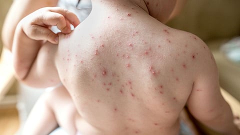 Dermatitis Pox