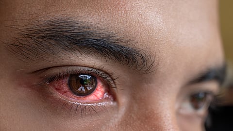 Eye Disease