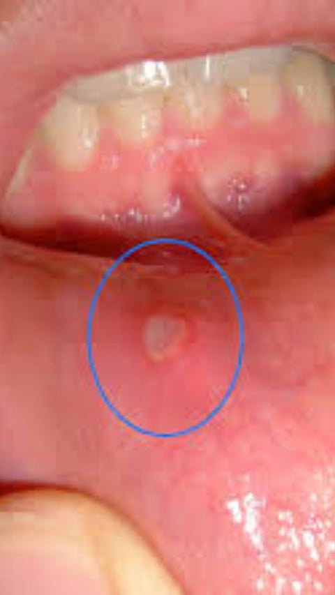 Mouth Ulcers : 