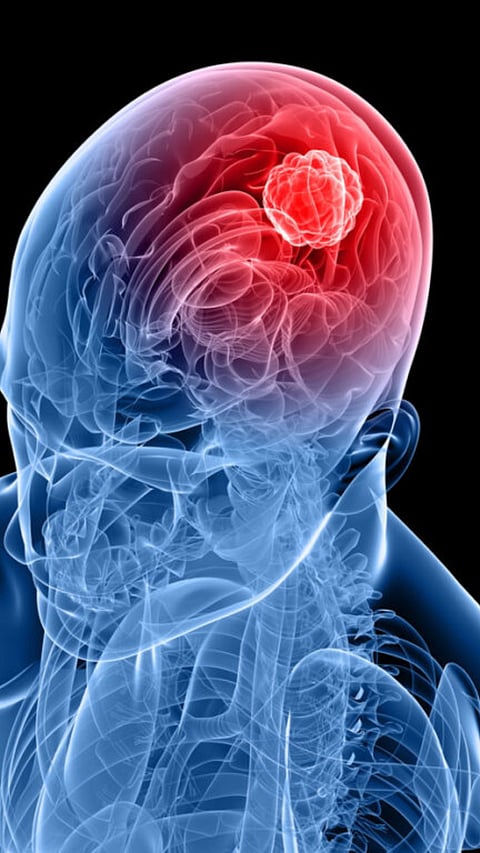 Early Signs Of Tumor