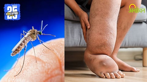 Filaria Disease