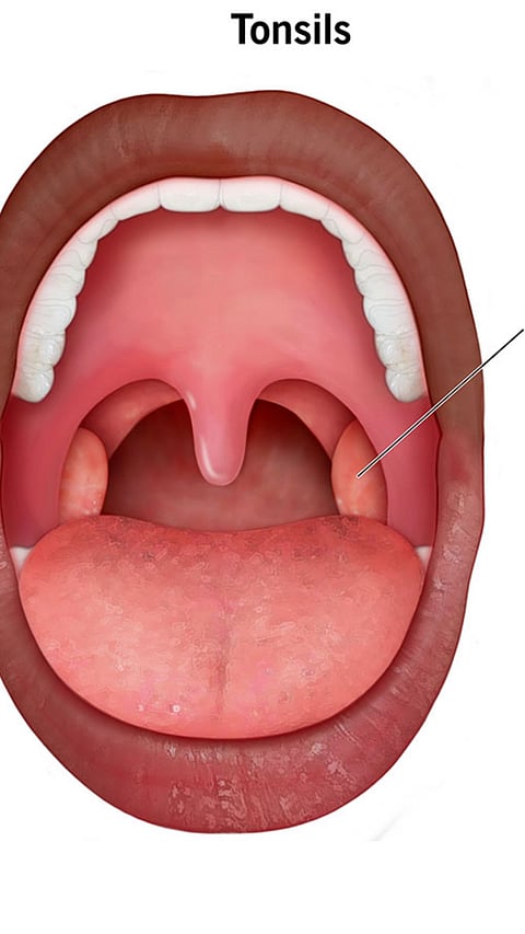 Tonsils Home Remedies