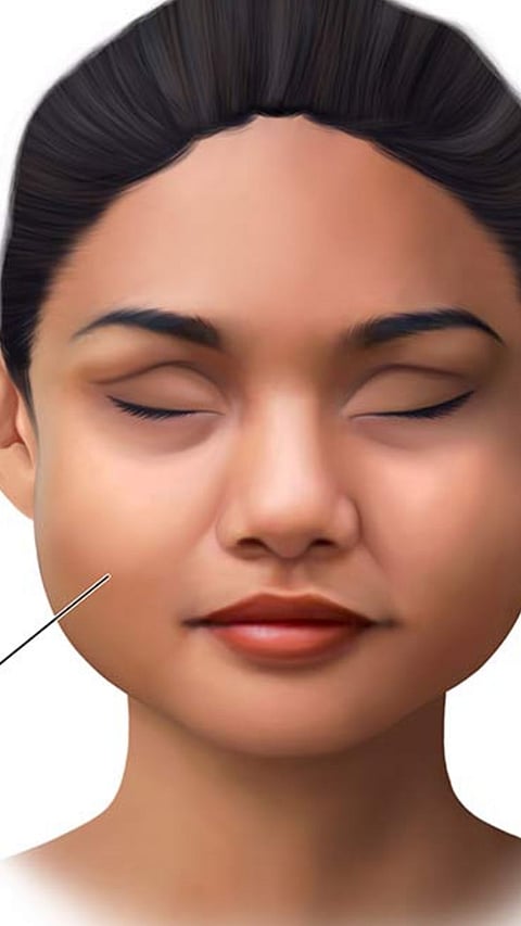 Puffy Face Remedies