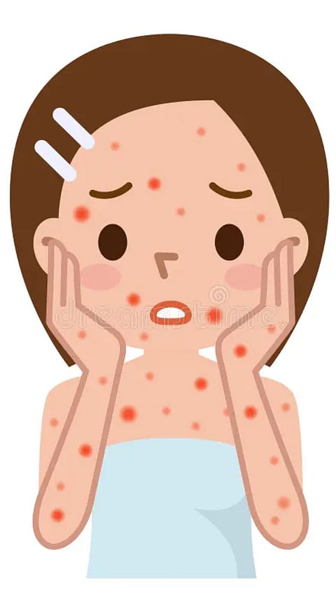 Measles & Chickenpox