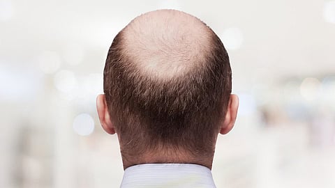 bald man
